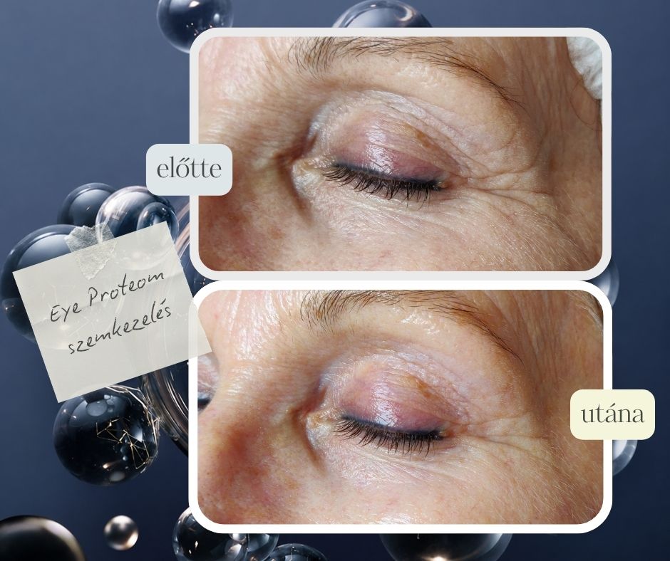 Eye Proteom szemkörnyéki masszázs