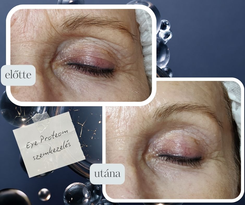 Eye Proteom szemkörnyéki masszázs
