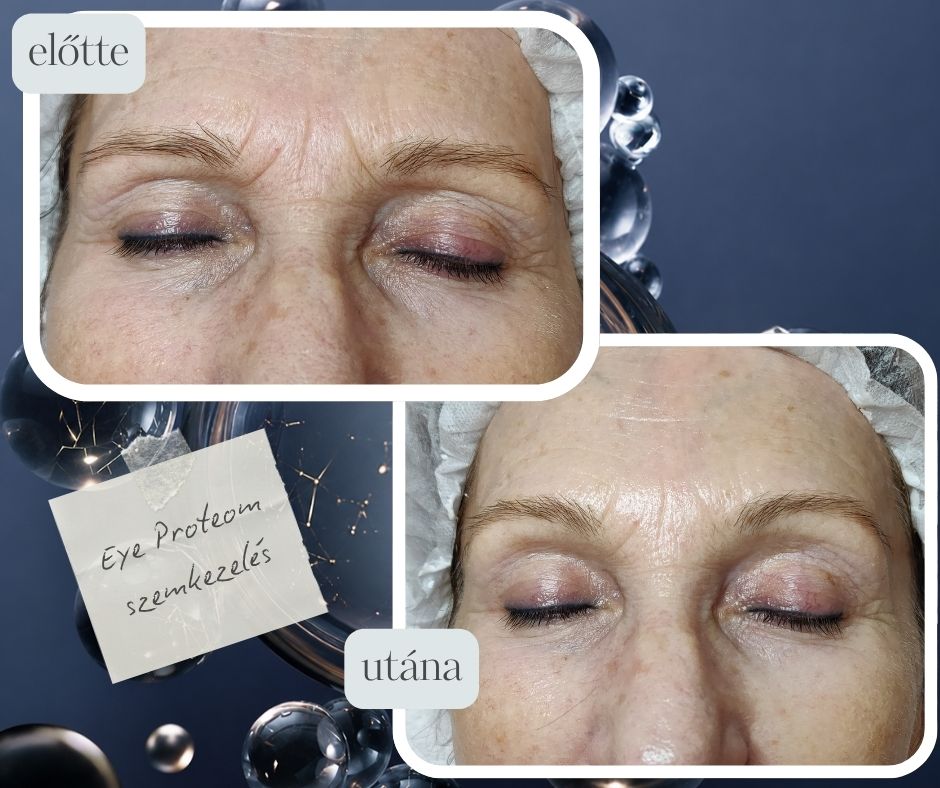 Eye Proteom szemkörnyéki masszázs